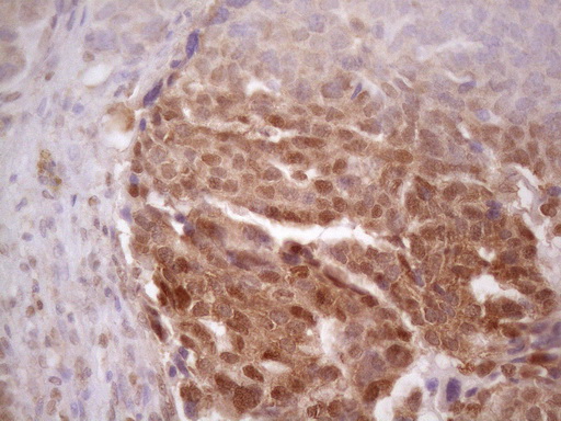 PRPK / TP53RK Antibody - Immunohistochemical staining of paraffin-embedded Adenocarcinoma of Human ovary tissue using anti-TP53RK mouse monoclonal antibody. (Heat-induced epitope retrieval by 1 mM EDTA in 10mM Tris, pH8.5, 120C for 3min. (1:150)