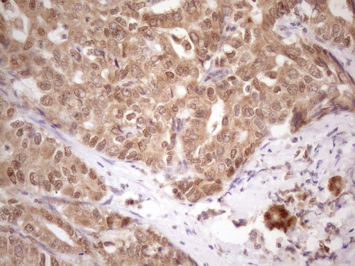 PRPK / TP53RK Antibody - Immunohistochemical staining of paraffin-embedded Carcinoma of Human liver tissue using anti-TP53RK mouse monoclonal antibody. (Heat-induced epitope retrieval by 1 mM EDTA in 10mM Tris, pH8.5, 120C for 3min. (1:150)