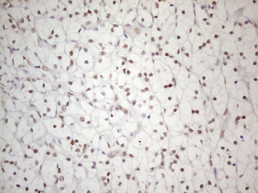 PRPK / TP53RK Antibody - Immunohistochemical staining of paraffin-embedded Carcinoma of Human kidney tissue using anti-TP53RK mouse monoclonal antibody. (Heat-induced epitope retrieval by 1mM EDTA in 10mM Tris buffer. (pH8.5) at 120°C for 3 min. (1:150)