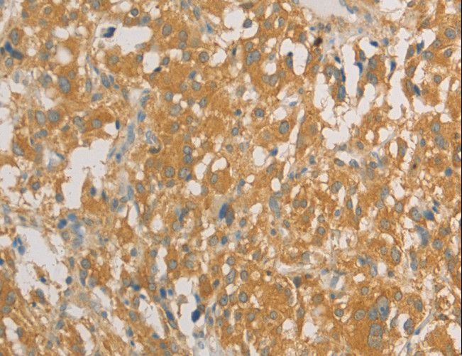 PRPSAP1 Antibody - Immunohistochemistry of paraffin-embedded Human liver cancer using PRPSAP1 Polyclonal Antibody at dilution of 1:80.