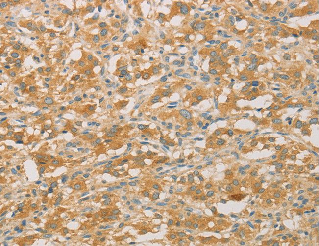 PRPSAP1 Antibody - Immunohistochemistry of paraffin-embedded Human gastric cancer using PRPSAP1 Polyclonal Antibody at dilution of 1:50.