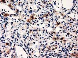 PRPSAP2 Antibody - Immunohistochemical staining of paraffin-embedded Carcinoma of Human kidney tissue using anti-PRPSAP2 mouse monoclonal antibody.