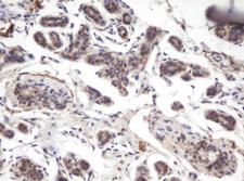 PRR11 Antibody - IHC of paraffin-embedded Human breast tissue using anti-PRR11 mouse monoclonal antibody. (Heat-induced epitope retrieval by 10mM citric buffer, pH6.0, 100C for 10min).