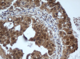 PRR11 Antibody - IHC of paraffin-embedded Adenocarcinoma of Human breast tissue using anti-PRR11 mouse monoclonal antibody. (Heat-induced epitope retrieval by 10mM citric buffer, pH6.0, 100C for 10min).
