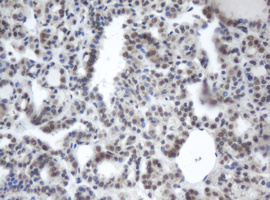 PRR11 Antibody - IHC of paraffin-embedded Carcinoma of Human thyroid tissue using anti-PRR11 mouse monoclonal antibody. (Heat-induced epitope retrieval by 10mM citric buffer, pH6.0, 100C for 10min).
