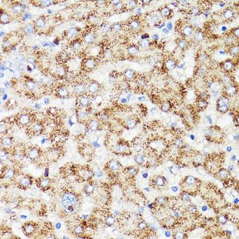 PRR11 Antibody - Immunohistochemistry of paraffin-embedded Human liver cancer using PRR11 Polyclonal Antibody at dilution of 1:100 (40x lens).