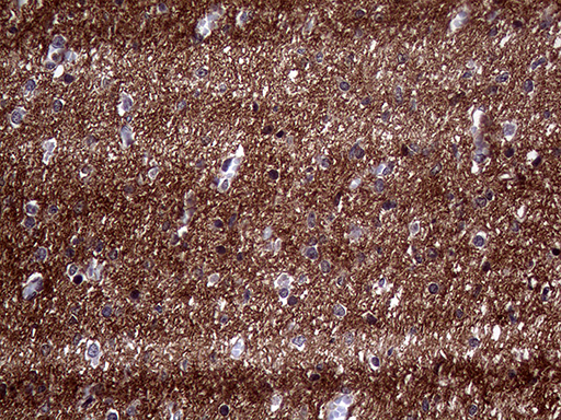 PRRT2 Antibody - Immunohistochemical staining of paraffin-embedded Human testicular cancer tissue using anti-PRRT2 mouse monoclonal antibody. (Heat-induced epitope retrieval by 1mM EDTA in 10mM Tris buffer. (pH8.5) at 120 oC for 3 min. (1:2000)