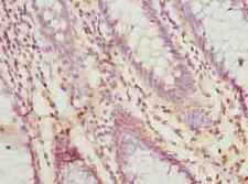 PRSS35 Antibody - Immunohistochemistry of paraffin-embedded human colon cancer using antibody at dilution of 1:100.