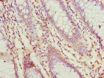 PRSS35 Antibody - Immunohistochemistry of paraffin-embedded human colon cancer using PRSS35 Antibody at dilution of 1:100