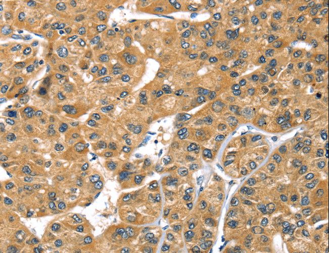 PRSS50 / TSP50 Antibody - Immunohistochemistry of paraffin-embedded Human liver cancer using PRSS50 Polyclonal Antibody at dilution of 1:30.