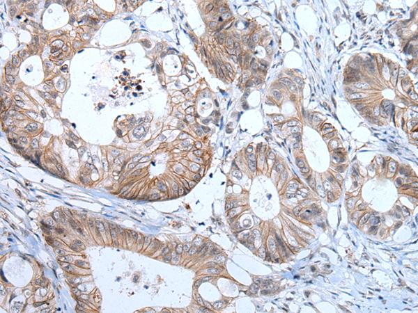 PRSS50 / TSP50 Antibody - Immunohistochemistry of paraffin-embedded Human colorectal cancer tissue  using PRSS50 Polyclonal Antibody at dilution of 1:65(×200)