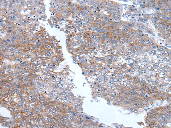 PRSS50 / TSP50 Antibody - Immunohistochemistry of paraffin-embedded Human liver cancer tissue  using PRSS50 Polyclonal Antibody at dilution of 1:65(×200)