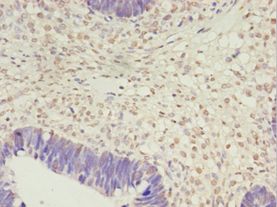 PRTFDC1 / HHGP Antibody - Immunohistochemistry of paraffin-embedded human ovarian cancer using antibody at 1:100 dilution.  This image was taken for the unconjugated form of this product. Other forms have not been tested.