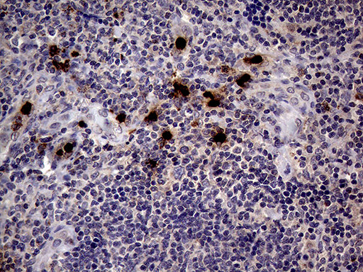 PRTN3 / Myeloblastin Antibody - Immunohistochemical staining of paraffin-embedded Human lymphoma tissue using anti-PRTN3 mouse monoclonal antibody. (Heat-induced epitope retrieval by 1mM EDTA in 10mM Tris buffer. (pH8.5) at 120°C for 3 min. (1:2000)
