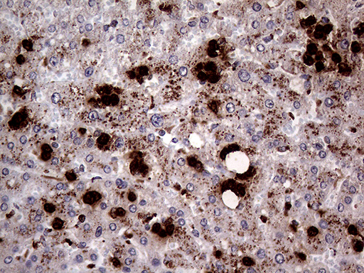 PRTN3 / Myeloblastin Antibody - Immunohistochemical staining of paraffin-embedded Carcinoma of Human liver tissue using anti-PRTN3 mouse monoclonal antibody. (Heat-induced epitope retrieval by 1mM EDTA in 10mM Tris buffer. (pH8.5) at 120°C for 3 min. (1:2000)