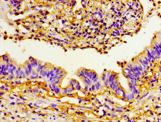 PRTN3 / Myeloblastin Antibody - Immunohistochemistry image of paraffin-embedded human lung cancer at a dilution of 1:100