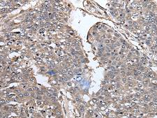 PRUNE Antibody - Immunohistochemistry of paraffin-embedded Human liver cancer tissue  using PRUNE Polyclonal Antibody at dilution of 1:40(×200)