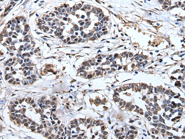 PRUNE Antibody - Immunohistochemistry of paraffin-embedded Human esophagus cancer tissue  using PRUNE Polyclonal Antibody at dilution of 1:40(×200)