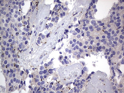 PRX-1 / PRRX1 Antibody - IHC of paraffin-embedded Adenocarcinoma of Human breast tissue using anti-PRRX1 mouse monoclonal antibody. (Heat-induced epitope retrieval by 1 mM EDTA in 10mM Tris, pH8.5, 120°C for 3min).