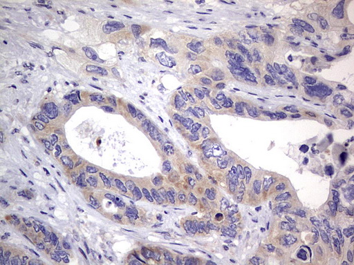 PRX-1 / PRRX1 Antibody - IHC of paraffin-embedded Adenocarcinoma of Human colon tissue using anti-PRRX1 mouse monoclonal antibody. (Heat-induced epitope retrieval by 1 mM EDTA in 10mM Tris, pH8.5, 120°C for 3min).