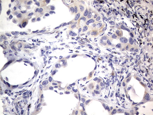 PRX-1 / PRRX1 Antibody - IHC of paraffin-embedded Carcinoma of Human lung tissue using anti-PRRX1 mouse monoclonal antibody. (Heat-induced epitope retrieval by 1 mM EDTA in 10mM Tris, pH8.5, 120°C for 3min).