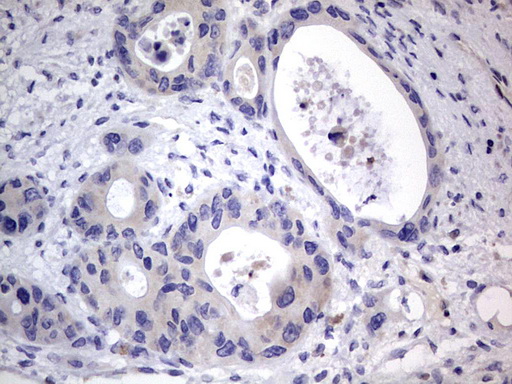 PRX-1 / PRRX1 Antibody - IHC of paraffin-embedded Carcinoma of Human pancreas tissue using anti-PRRX1 mouse monoclonal antibody. (Heat-induced epitope retrieval by 1 mM EDTA in 10mM Tris, pH8.5, 120°C for 3min).