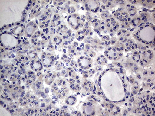 PRX-1 / PRRX1 Antibody - IHC of paraffin-embedded Carcinoma of Human thyroid tissue using anti-PRRX1 mouse monoclonal antibody. (Heat-induced epitope retrieval by 1 mM EDTA in 10mM Tris, pH8.5, 120°C for 3min).