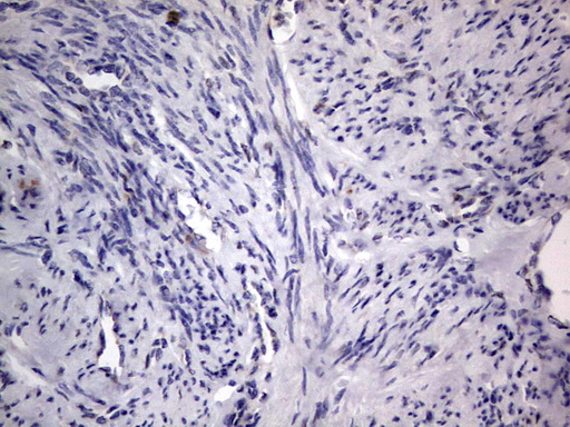 PRX-1 / PRRX1 Antibody - IHC of paraffin-embedded Adenocarcinoma of Human endometrium tissue using anti-PRRX1 mouse monoclonal antibody. (Heat-induced epitope retrieval by 1 mM EDTA in 10mM Tris, pH8.5, 120°C for 3min).