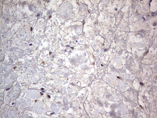 PRX-1 / PRRX1 Antibody - IHC of paraffin-embedded Human bladder tissue using anti-PRRX1 mouse monoclonal antibody. (Heat-induced epitope retrieval by 1 mM EDTA in 10mM Tris, pH8.5, 120°C for 3min).