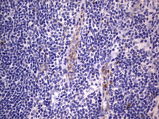 PRX-1 / PRRX1 Antibody - IHC of paraffin-embedded Human lymphoma tissue using anti-PRRX1 mouse monoclonal antibody. (Heat-induced epitope retrieval by 1 mM EDTA in 10mM Tris, pH8.5, 120°C for 3min).