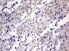 PRX-1 / PRRX1 Antibody - IHC of paraffin-embedded Adenocarcinoma of Human ovary tissue using anti-PRRX1 mouse monoclonal antibody. (Heat-induced epitope retrieval by 1 mM EDTA in 10mM Tris, pH8.5, 120°C for 3min).