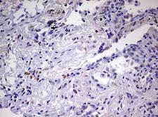 PRX-1 / PRRX1 Antibody - IHC of paraffin-embedded Carcinoma of Human lung tissue using anti-PRRX1 mouse monoclonal antibody. (Heat-induced epitope retrieval by 10mM citric buffer, pH6.0, 120°C for 3min).