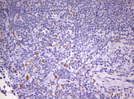 PRX-1 / PRRX1 Antibody - IHC of paraffin-embedded Human lymphoma tissue using anti-PRRX1 mouse monoclonal antibody. (Heat-induced epitope retrieval by 10mM citric buffer, pH6.0, 120°C for 3min).