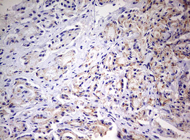 PRX-1 / PRRX1 Antibody - IHC of paraffin-embedded Carcinoma of Human prostate tissue using anti-PRRX1 mouse monoclonal antibody. (Heat-induced epitope retrieval by 10mM citric buffer, pH6.0, 120°C for 3min).