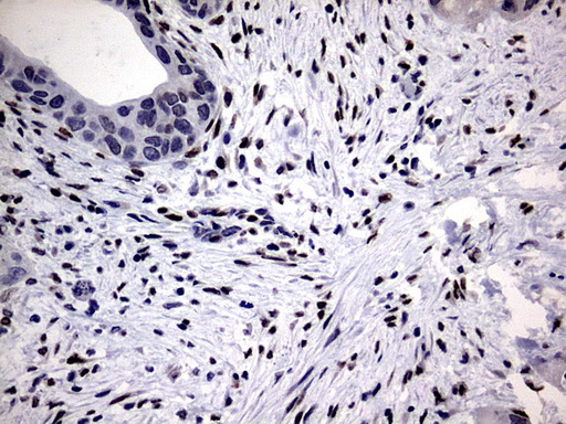 PRX-1 / PRRX1 Antibody - IHC of paraffin-embedded Carcinoma of Human pancreas tissue using anti-PRRX1 mouse monoclonal antibody. (Heat-induced epitope retrieval by 10mM citric buffer, pH6.0, 120°C for 3min).