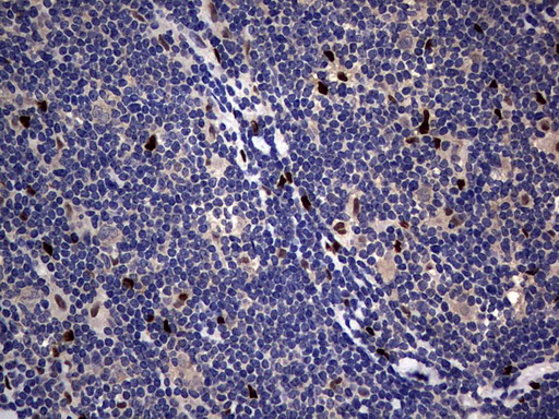 PRX-1 / PRRX1 Antibody - IHC of paraffin-embedded Human lymphoma tissue using anti-PRRX1 mouse monoclonal antibody. (Heat-induced epitope retrieval by 10mM citric buffer, pH6.0, 120°C for 3min).