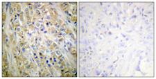 PSA-ACT Complex Antibody - Peptide - + Immunohistochemical analysis of paraffin-embedded human prostate carcinoma tissue using Prostate-specific Antigen antibody.