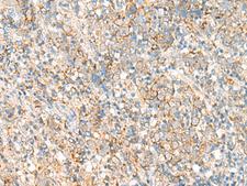 PSD4 Antibody - Immunohistochemistry of paraffin-embedded Human cervical cancer tissue  using PSD4 Polyclonal Antibody at dilution of 1:50(×200)