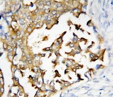 PSEN2 / Presenilin 2 Antibody - IHC-P: Presenilin 2 antibody testing of human breast cancer tissue