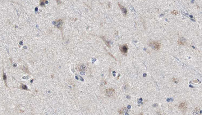 PSEN2 / Presenilin 2 Antibody - 1:100 staining human brain carcinoma tissue by IHC-P. The sample was formaldehyde fixed and a heat mediated antigen retrieval step in citrate buffer was performed. The sample was then blocked and incubated with the antibody for 1.5 hours at 22°C. An HRP conjugated goat anti-rabbit antibody was used as the secondary.