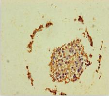 PSF1 / GINS2 Antibody - Immunohistochemistry of paraffin-embedded human breast cancer using Rabbit anti-human DNA replication complex GINS protein PSF2 polyclonal Antibody(GINS2) at dilution of 1:100