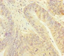 PSF1 / GINS2 Antibody - Immunohistochemistry of paraffin-embedded human colon cancer at dilution of 1:100