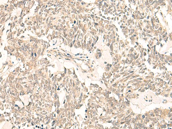 PSF1 / GINS2 Antibody - Immunohistochemistry of paraffin-embedded Human lung cancer tissue  using GINS2 Polyclonal Antibody at dilution of 1:50(×200)
