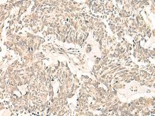 PSF1 / GINS2 Antibody - Immunohistochemistry of paraffin-embedded Human lung cancer tissue  using GINS2 Polyclonal Antibody at dilution of 1:50(×200)
