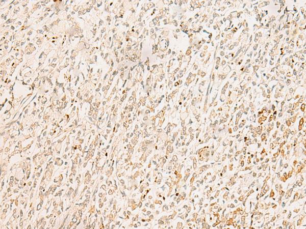 PSF1 / GINS2 Antibody - Immunohistochemistry of paraffin-embedded Human gastric cancer tissue  using GINS2 Polyclonal Antibody at dilution of 1:50(×200)