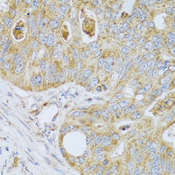 PSG1 / CD66f Antibody - Immunohistochemistry of paraffin-embedded human colon carcinoma tissue.