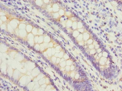 PSG3 Antibody - Immunohistochemistry of paraffin-embedded human colon cancer using antibody at dilution of 1:100.