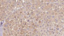 PSG3 Antibody - 1:100 staining human Melanoma tissue by IHC-P. The sample was formaldehyde fixed and a heat mediated antigen retrieval step in citrate buffer was performed. The sample was then blocked and incubated with the antibody for 1.5 hours at 22°C. An HRP conjugated goat anti-rabbit antibody was used as the secondary.