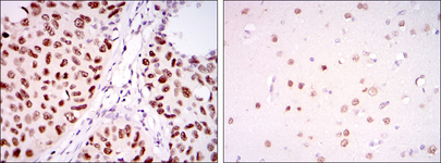 PSIP1 / LEDGF Antibody - IHC of paraffin-embedded lung cancer tissues (left) and brain tissues (right) using PSIP1 mouse monoclonal antibody with DAB staining.