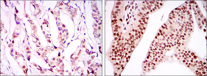 PSIP1 / LEDGF Antibody - IHC of paraffin-embedded breast cancer tissues (left) and ovarian cancer tissues (right) using PSIP1 mouse monoclonal antibody with DAB staining.